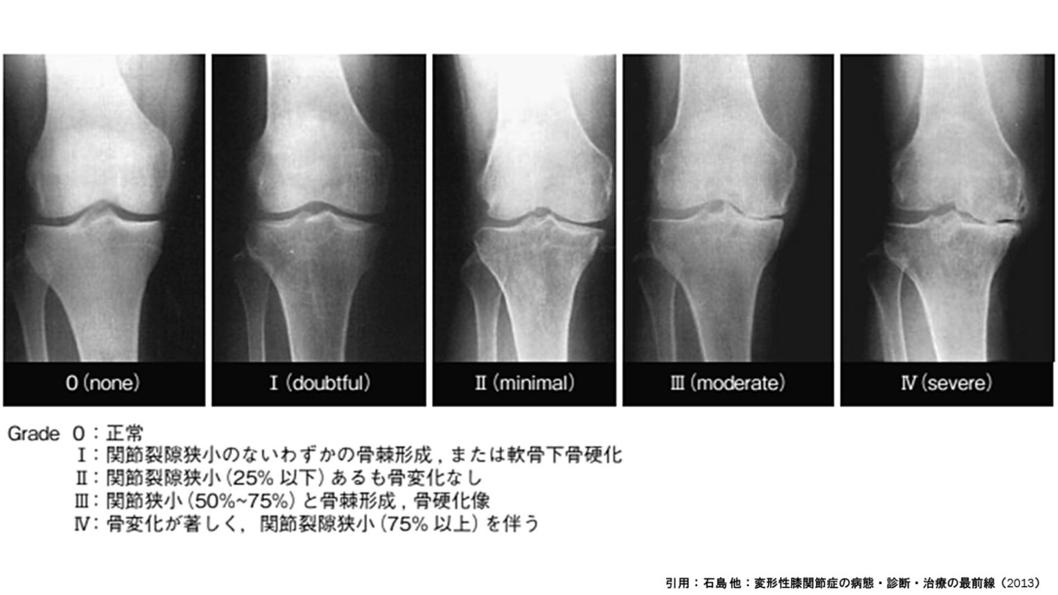 変形性膝関節症（膝OA）とは？ - いちかわ魚屋整体 with Overlization