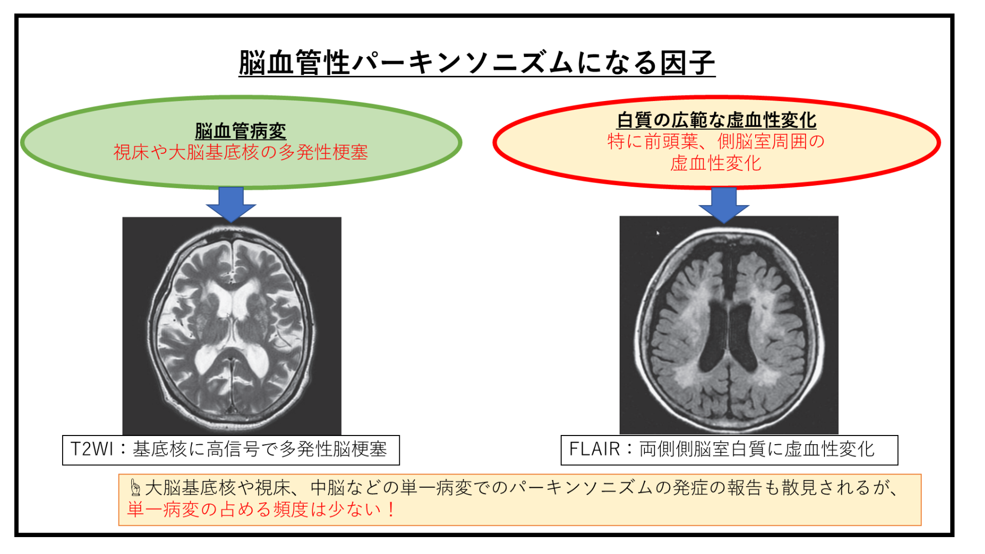 脳血管性パーキンソニズムの定義や特徴とは？ いちかわ魚屋整体 with Overlization